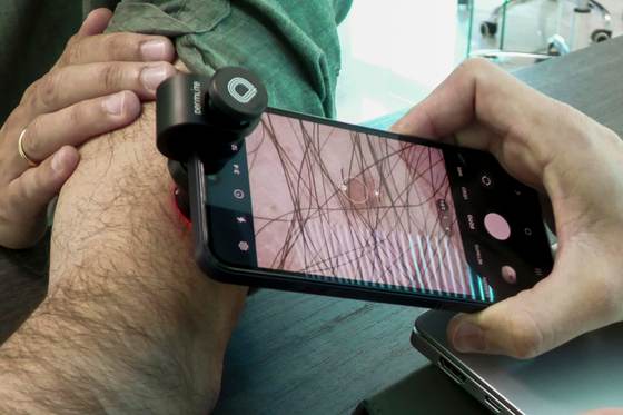 México registra 2.198 casos de melanoma al año; 80 % llega tarde al diagnóstico