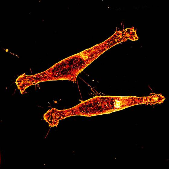 Hallan una nueva vía para intentar frenar la enfermedad de Huntington