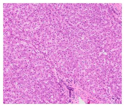 La quimioterapia infantil con platino deja una huella permanente en los tejidos sanos