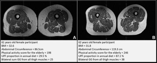 La dietas altas en alimentos ultraprocesados también alteran la salud muscular