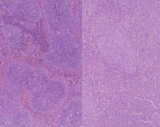 Identifican unos genes que pueden predecir la supervivencia en leucemia mieloide aguda