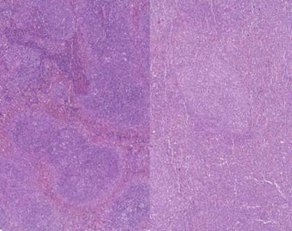 Identifican unos genes que pueden predecir la supervivencia en leucemia mieloide aguda