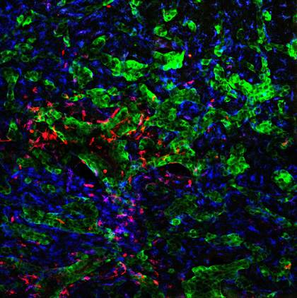 Descubren cómo las células tumorales alteran el cerebro y logran diseminar el cáncer