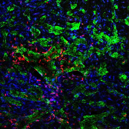 Descubren cómo las células tumorales alteran el cerebro y logran diseminar el cáncer