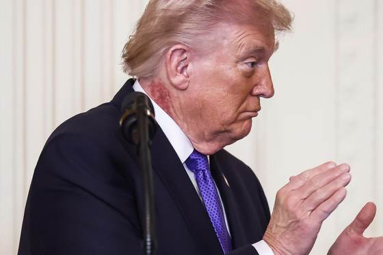 Trump luce un sarpullido en el cuello, que su médico atribuye a un tratamiento preventivo