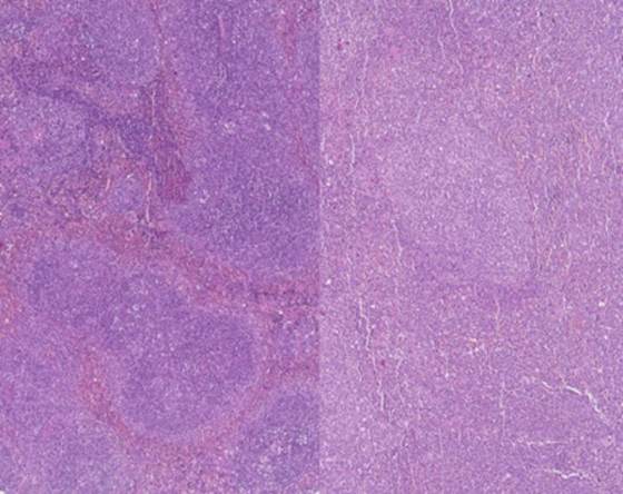 Identifican unos genes que pueden predecir la supervivencia en leucemia mieloide aguda