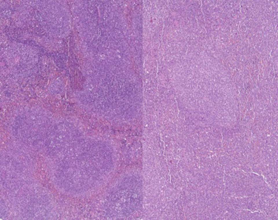 Identifican unos genes que pueden predecir la supervivencia en leucemia mieloide aguda