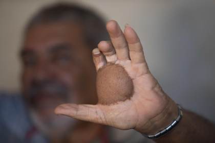 Los sobrevivientes del accidente radiactivo de Goiania: “Hay discriminación hasta hoy”